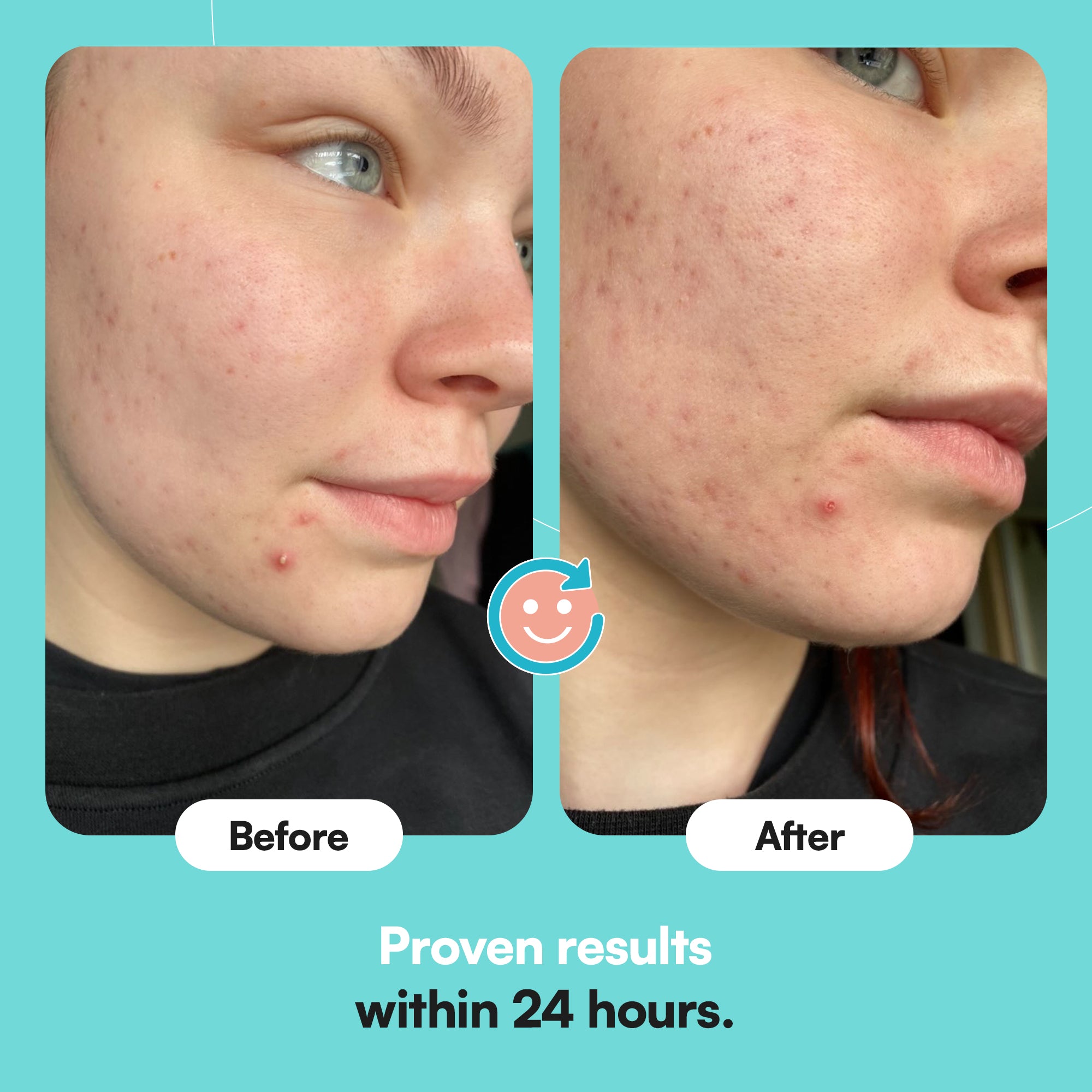 Through the window The Holy Grail - Acne Patches